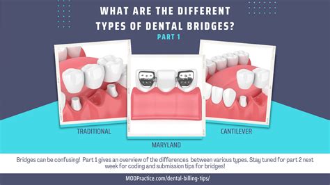 What Type Of Metal Is Used In Dental Bridges at Sean Freeleagus blog