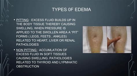 Edema and it's types ( presentation ) medicine | PDF