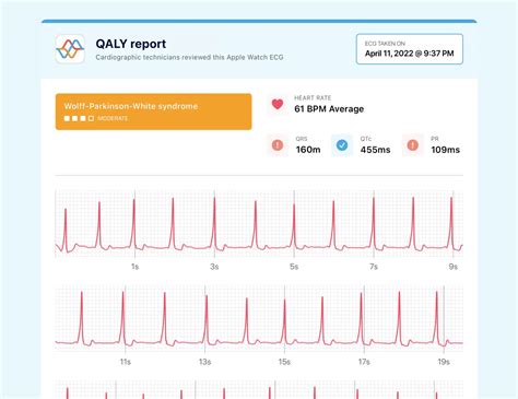 PR Interval on Your Watch ECG - Short, Normal, and Prolonged | Qaly
