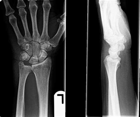 Pisiform fracture: an uncommon wrist injury | BMJ Case Reports