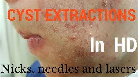 Image result for Largest Infected Exploding Cyst Carbuncle Blackhead