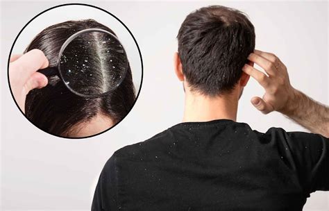 Dandruff - Symptoms, causes, types, Diagnosis and How To Get Rid