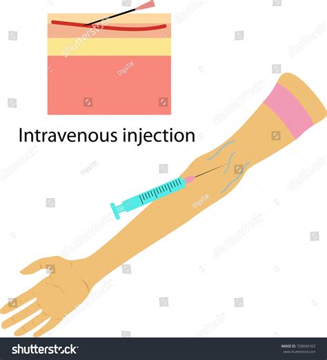 Intravenous Injection Diagram Intravenous Practice Arm Kit PVC High