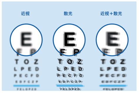 眼睛散光是怎么形成的？如何防控矫正？ - 知乎