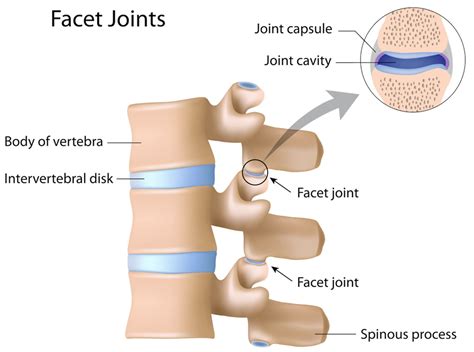 Lumbar Facet Syndrome