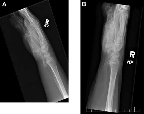 Calcium Deposits In Wrist Joint OrthoDx: Calcific Tendinitis Of The