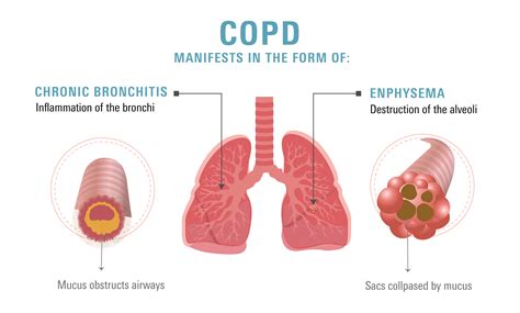Emphysema Life Expectancy 的图像结果
