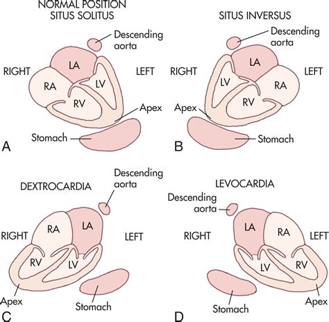 Fetal Echocardiography: Congenital Heart Disease - Clinical Tree
