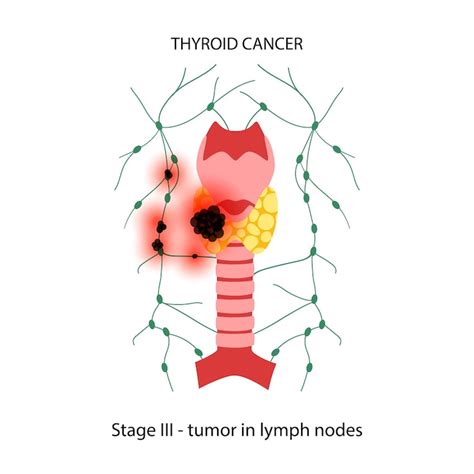Page 7 | Thyroid hormone imbalance Images - Free Download on Freepik