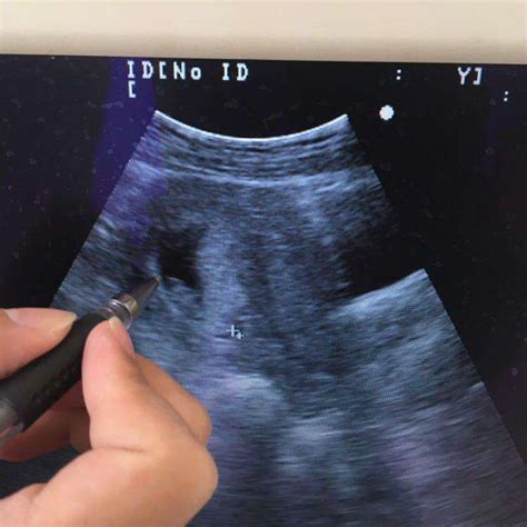 做试管婴儿，胚胎移植后怀孕周期和预产期怎么算_腾讯新闻