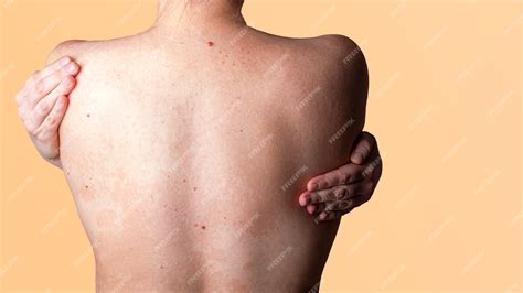 Allergic dermatitis on the skin of a woman's back. skin disease ...