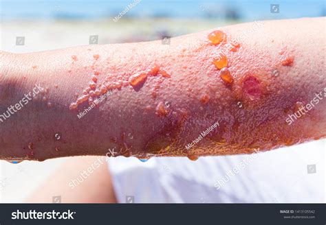 Severe Painful Poison Ivy Rash Infection ภาพสต็อก 1413105542 | Shutterstock