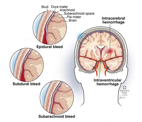 Epidural Hematoma vs Subdural Hematoma vs Subarachnoid Hemorrhage