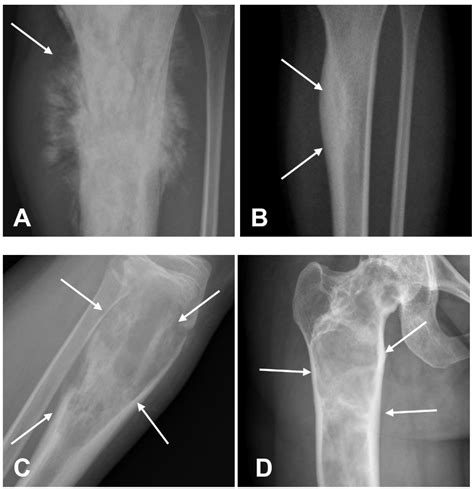 Sarcoma De Ewing Vs. Osteosarcoma