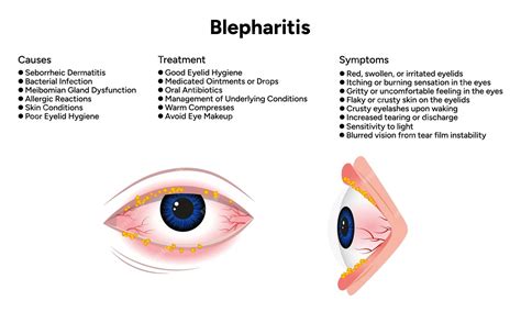 What Causes Blepharitis