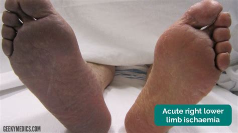 Peripheral Vascular Examination - OSCE Guide | Geeky Medics