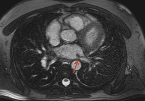 Recurrent haemoptysis as a symptom of severe pulmonary vein stenosis—a ...