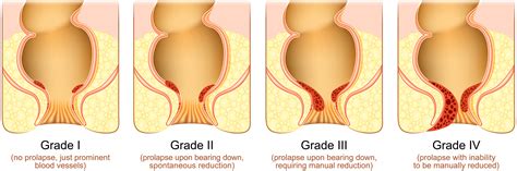 Hemorrhoid Grading System: Grade 1 to 4 Explained