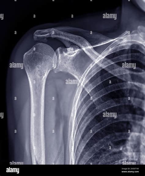 X Ray Shoulder Joint