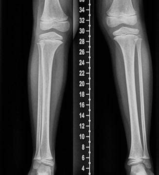 The Foot and Ankle: Congenital and Developmental Conditions | Radiology Key