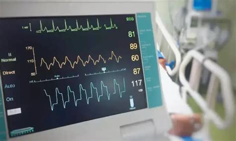 Stress ECG positivity may reveal coronary microvascular dysfunction in ...