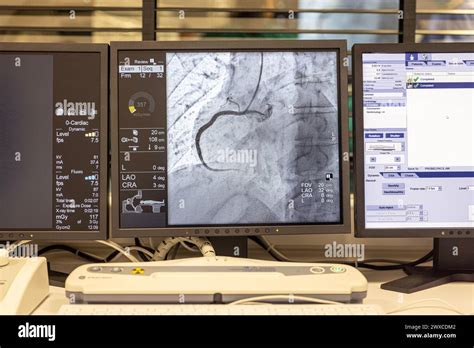 Image result for How Angiogram Is Done