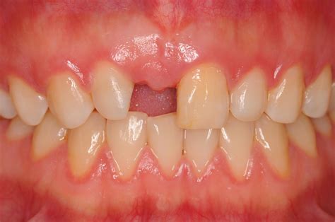 太原牙齿矫正丨门牙中间有一颗多生牙是怎样一种“体验”？？ - 知乎