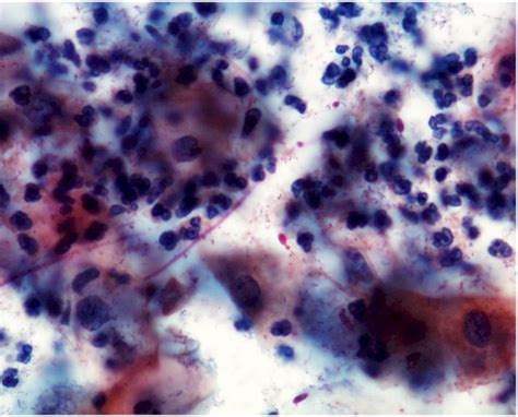 Kuvatulokset haulle candida