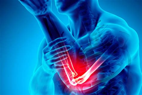 Tratamiento fisioterapéutico para Epicondilitis Lateral (Codo de ...