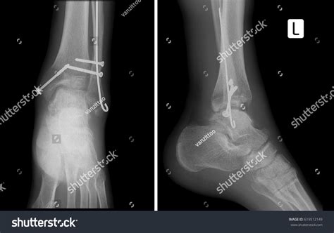 X Rays Of Broken Ankles JC. Should we X-ray before manipulating a displaced ankle ...