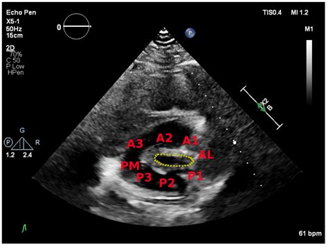 The Role of 2D and 3D Echo in Mitral Stenosis