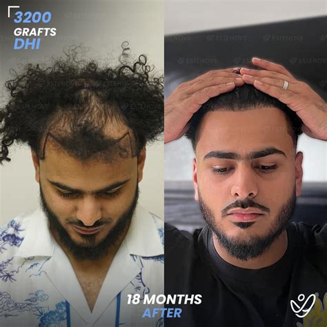 Hair Plugs vs. Hair Transplant in 2026: See the Difference