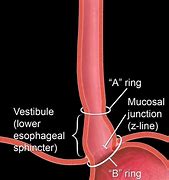 esophageal polyp 的图像结果