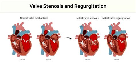 Mitral vs. Aortic Murmurs Made Extremely Easy | ACLS Resources | ACLS ...