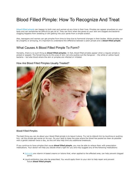 Blood Filled Pimple: How To Recognize And Treat by beautifullike - Issuu