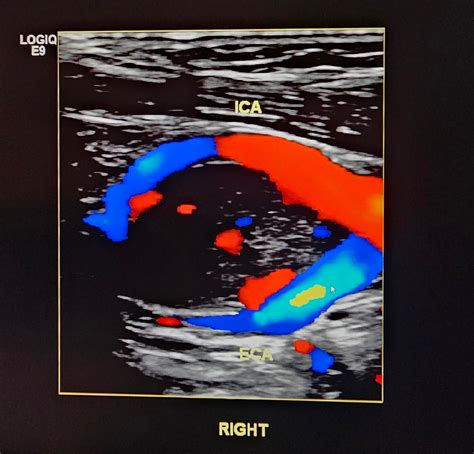 Carotid body tumor : r/Radiology