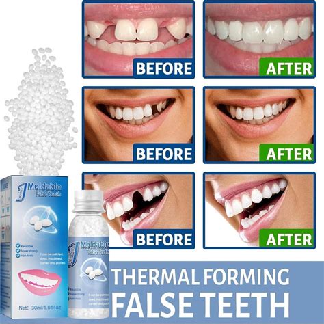DIY Moldable False Teeth Repair Kit - Instant Tooth Filling Replacement ...