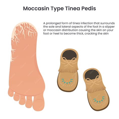 Premium Vector | Moccasin type tinea pedis athlete's food education vector infographic