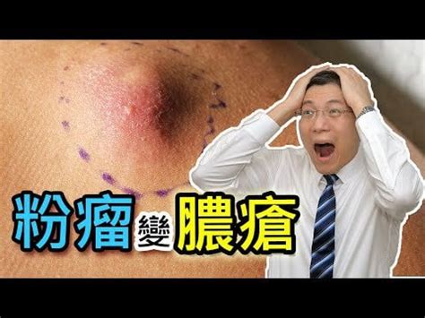 Image result for Back Full of Exploding Cysts