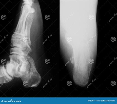 X-ray Image of Broken Calcaneus, AP and Axial View. Stock Image - Image ...