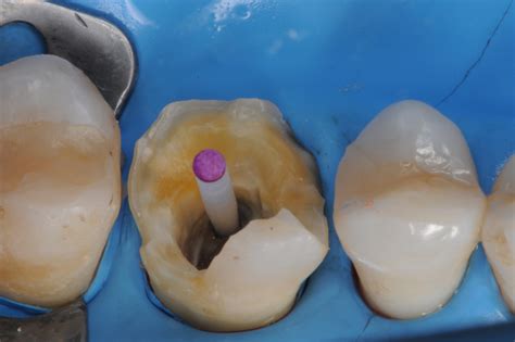 Temporary Crown Pain After 3 Weeks at Ruby Najar blog