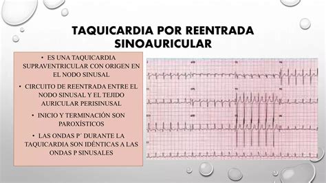 Taquicardias supraventriculares | PPTX