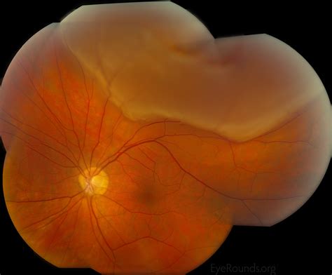 Vitreous Syneresis: An Impending Posterior Vitreous Detachment (PVD)