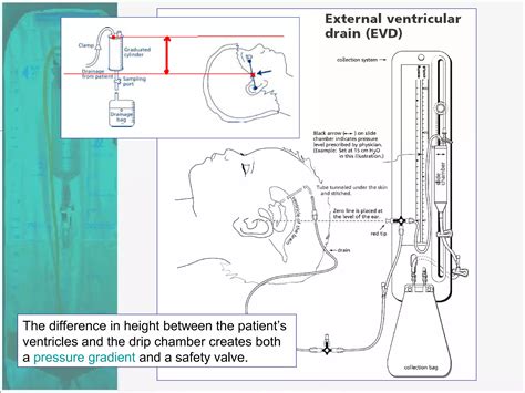 External Ventricular Drain | PPT