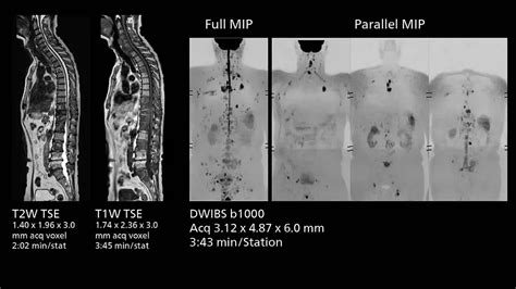 To a modern MRI without a change of magnet - Philips