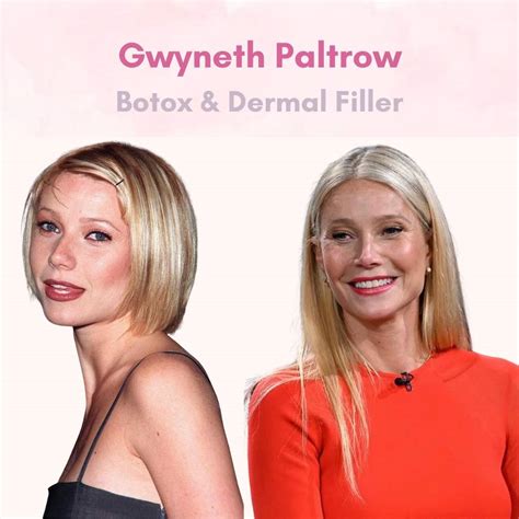 Gwyneth Paltrow Face Surgery