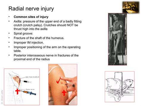 Surgical anatomy of nerve and vascular injuries in the upper limb | PPT