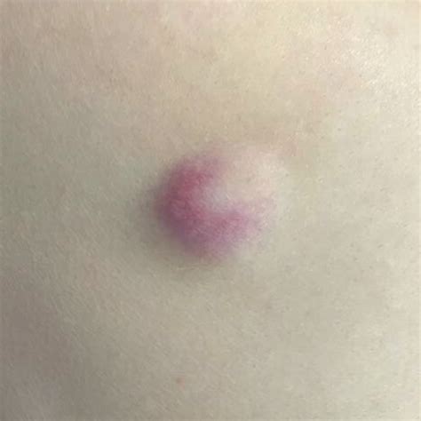 Pictures of Cysts Under the Skin | Common Types & Examples
