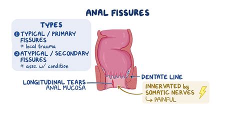 Video: Anal fissure: Clinical sciences | Osmosis