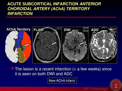 PPT - Ischemic Lesions as seen on CT/MRI PowerPoint Presentation, free ...